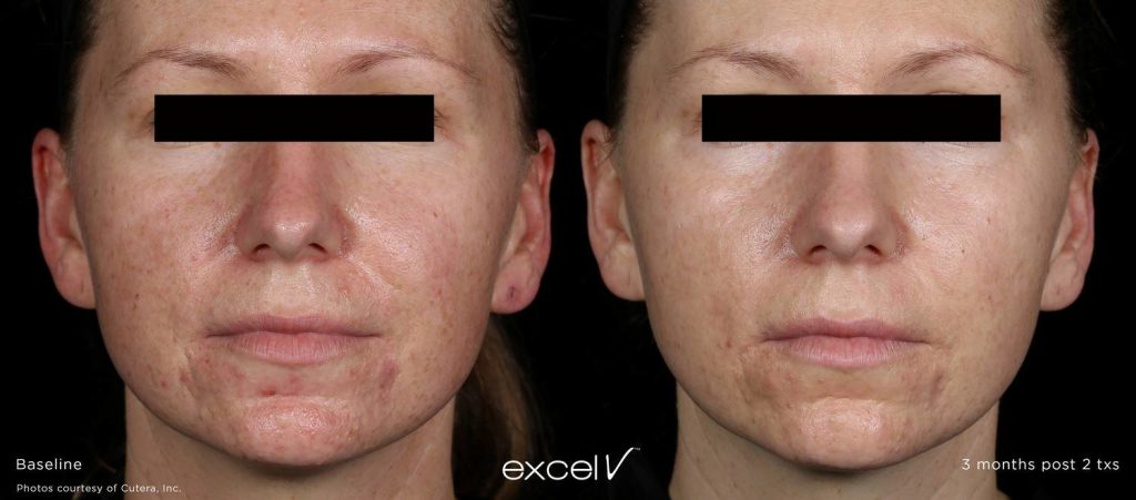 Before and after laser rejuvenation results