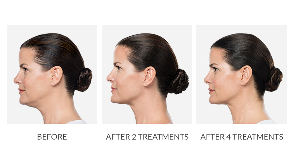 Before and after Kybella treatments