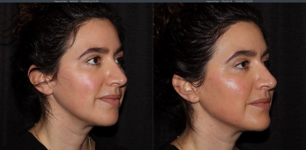 Before and after Volux treatment results