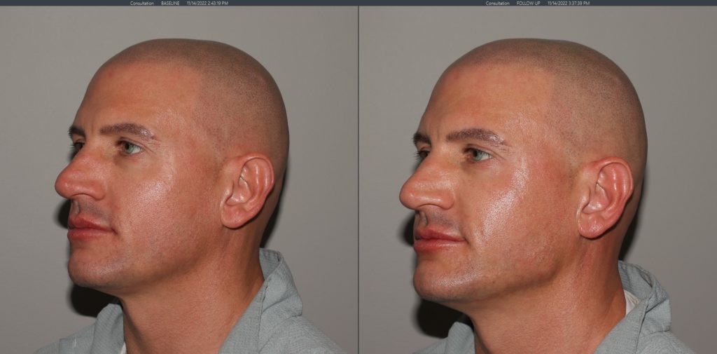 Before and after Volux treatment results